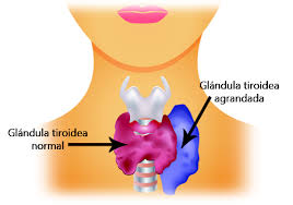 Algunas maneras de tratar el hipertiroidismo